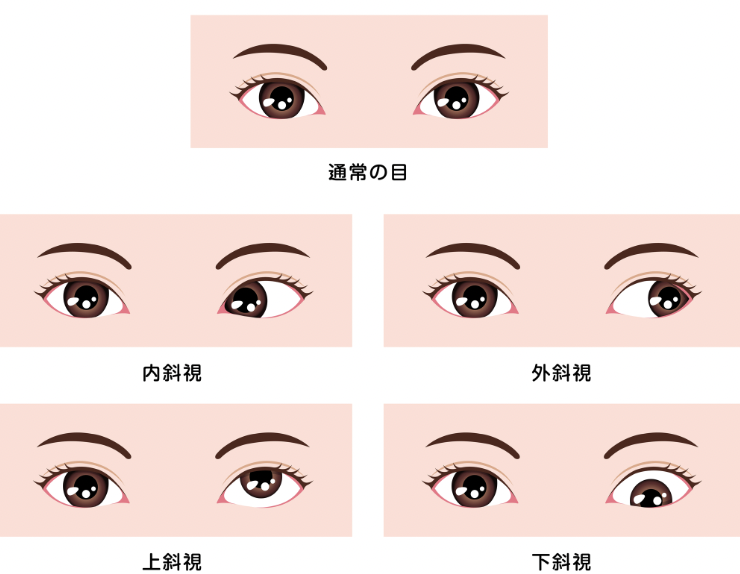 笹崎里菜が斜視と言われる理由と意味【顔画像】右目が気になる?