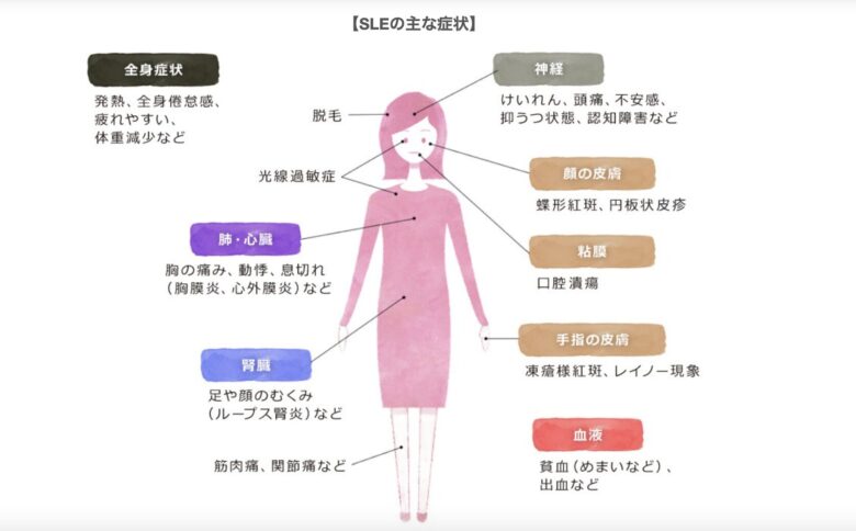 渡邊渚の病名は全身性エリテマトーデス?【SLE】症状と投稿3つの共通点