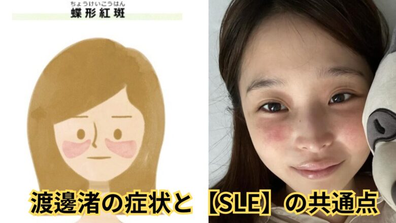 渡邊渚の病名は全身性エリテマトーデス?【SLE】症状と投稿3つの共通点